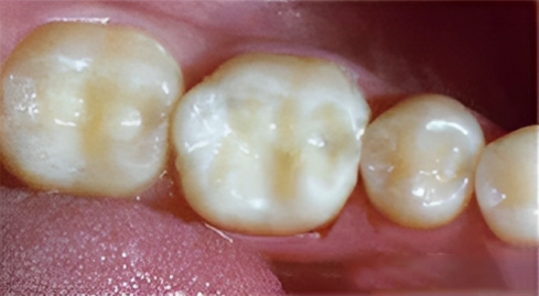 Dental Bonding in San Jose, CA - After Treatment