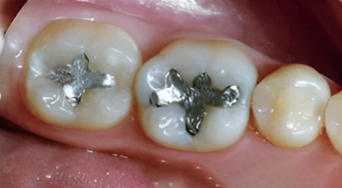Dental Bonding in San Jose, CA - Before Treatment
