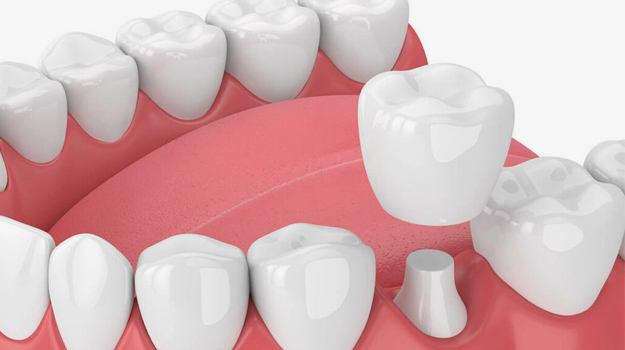 Dental Crowns in San Jose, CA