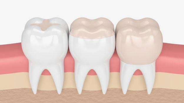 Inlays and Onlays in San Jose, CA