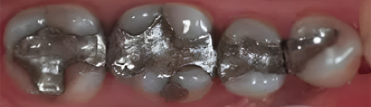 Inlays And Onlays in San Jose, CA - Before Treatment - Arbor Dental Group