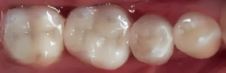 Inlays And Onlays in San Jose, CA - After Treatment - Arbor Dental Group