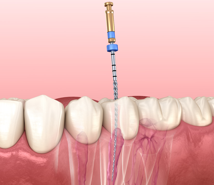 Root Canals in San Jose, CA