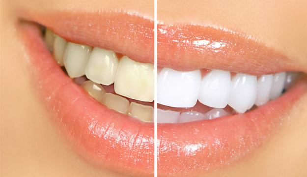 Teeth Whitening in San Jose, CA