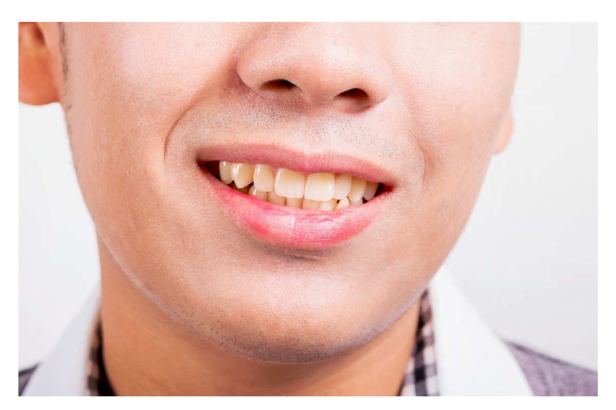 Teeth Discoloration