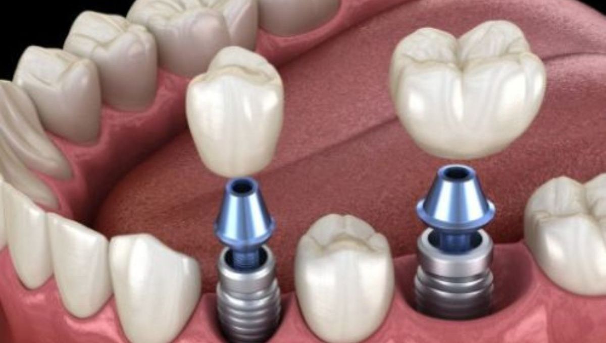 Dental Implant San Jose