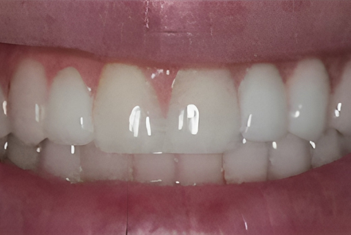 Dental Bridges in San Jose, CA - After Treatment - Arbor Dental Group