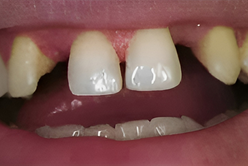 Dental Bridges in San Jose, CA - Before Treatment - Arbor Dental Group