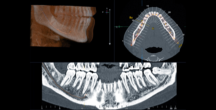 Dental CT Scan - Arbor Dental Group - San Jose, CA