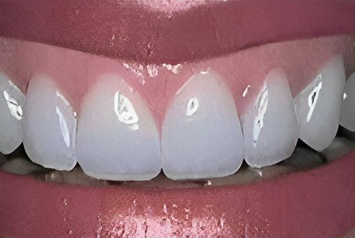 Dental Crowns in San Jose, CA - After Treatment - Arbor Dental Group