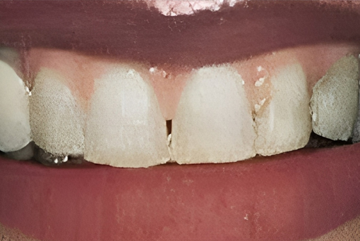Dental Crowns in San Jose, CA - Before Treatment - Arbor Dental Group