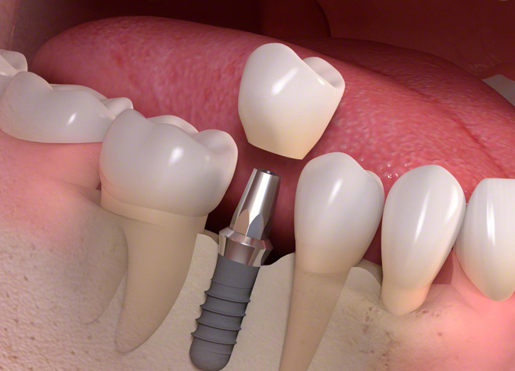 Dental Implant Surgery in San Jose, CA- Arbor Dental Group