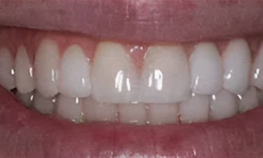 Dental Implants - San Jose CA - After Treatment - Arbor Dental Group