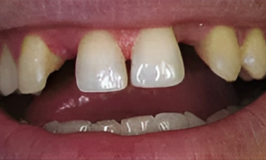 Dental Implants - San Jose CA - Before Treatment - Arbor Dental Group