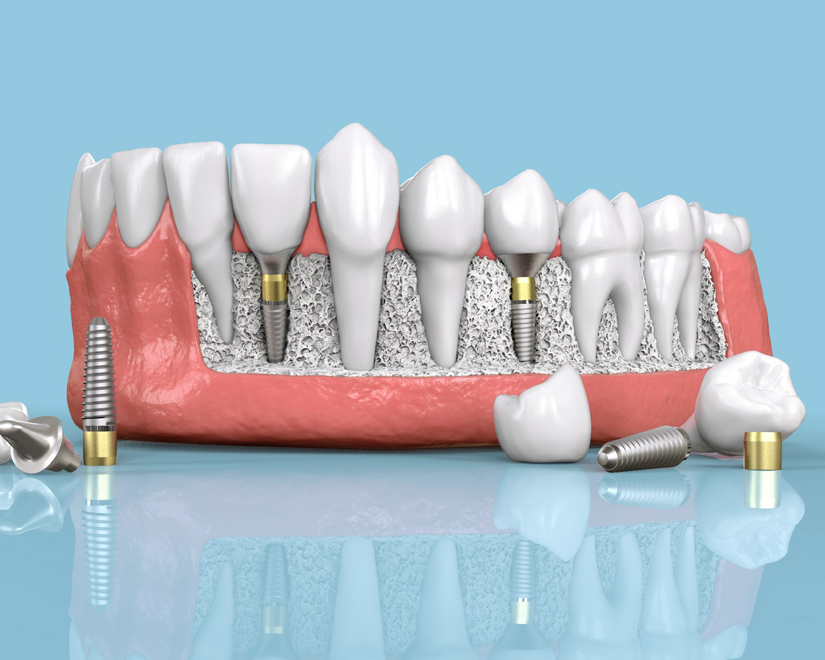 Dental Implants in San Jose, CA - Arbor Dental Group