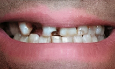 Dental Veneers - San Jose CA - Before Treatment - Arbor Dental Group