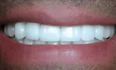 Dental Veneers San Jose, Dentist San Jose, Arbor Dental Group