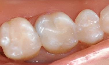 Dental fillings - San Jose CA - After Treatment - Arbor Dental Group