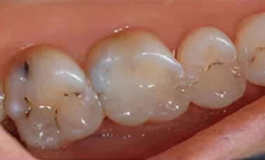 Dental fillings - San Jose CA - Before Treatment