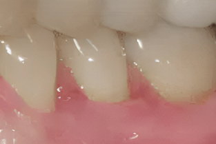 Gum Grafting in San Jose - After Treatment - Arbor Dental Group