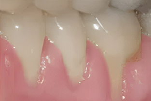 Gum Grafting in San Jose, CA - Before Treatment - Arbor Dental Group