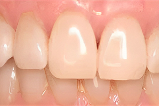 Gum Grafting in San Jose, CA - After Treatment - Arbor Dental Group