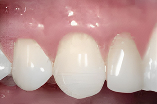 Gum Grafting in San Jose, CA - After Treatment - Arbor Dental Group