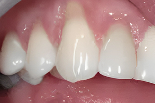 Gum Grafting in San Jose, CA - Arbor Dental Group - Before Treatment