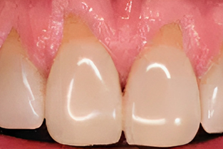 Gum Grafting in San Jose, CA - Before Treatment - Arbor Dental Group