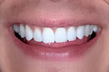 Minimal Prep Veneers in San Jose - After Treatment - Arbor Dental Group