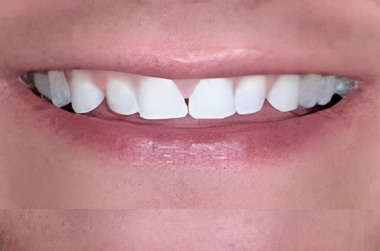 Minimal Prep Veneers in San Jose - Before Treatment - Arbor Dental Group