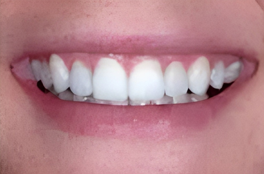 Minimal Prep Veneers in San Jose, CA - After Treatment - Arbor Dental Group
