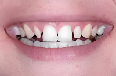 Minimal Prep Veneers in San Jose, CA - Before Treatment - Arbor Dental Group