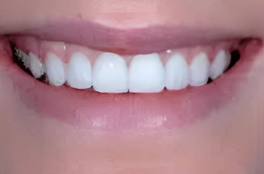 No-Prep Veneers in San Jose -  Arbor Dental Group - After Treatment 