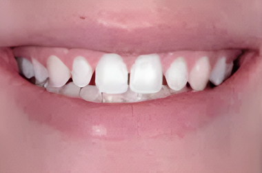 No-Prep Veneers in San Jose - Before Treatment - Arbor Dental Group