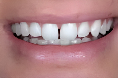 No-Prep Veneers in San Jose - Before Treatment - Arbor Dental Group