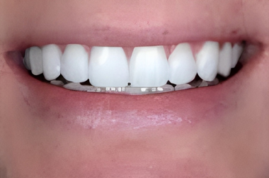 No-Prep Veneers in San Jose, CA - After Treatment  - Arbor Dental Group