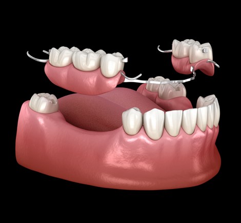 Partial Dentures in San Jose, CA - Arbor Dental Group