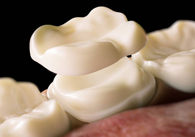 Porcelain Dental Restorations in San Jose, CA - Arbor Dental Group