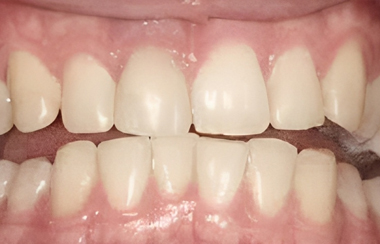 Porcelain Veneers in San Jose, Abor Dental Group