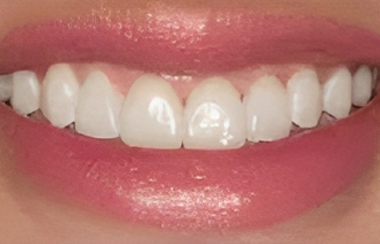Porcelain Veneers in San Jose, CA - After Treatment  - Arbor Dental Group