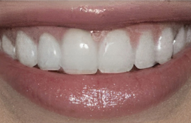 Porcelain Veneers in San Jose, CA - After Treatment  - Arbor Dental Group