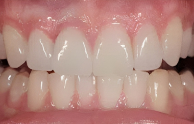 Porcelain Veneers in San Jose, CA - Arbor Dental Group -  After Treatment