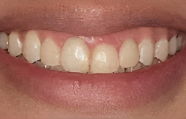Porcelain Veneers in San Jose, CA - Before Treatment - Arbor Dental Group