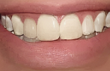 Porcelain Veneers in San Jose, CA - Before Treatment - Abor Dental Group