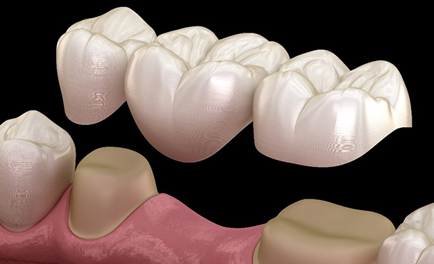 Dental Bridges in Communications Hill