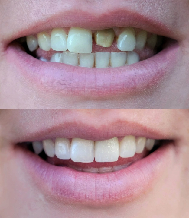 Teeth Whitening in San Jose, CA - Arbor Dental Group