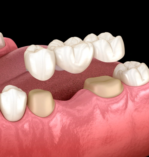 Revive Your Smile With Dental Crowns and Bridges in San Jose, CA