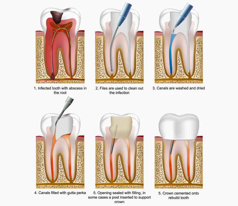 Root Canal Treatment in San Jose, CA- Arbor Dental Group